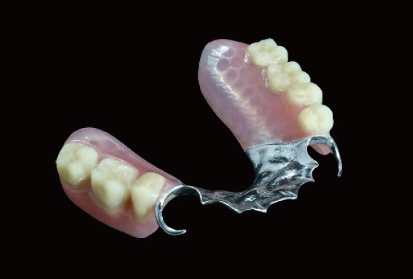 金属床義歯(部分義歯)